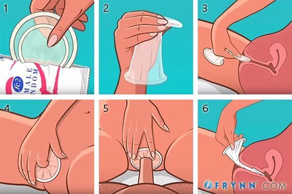 วิธีใช้ถุงยางผู้หญิง